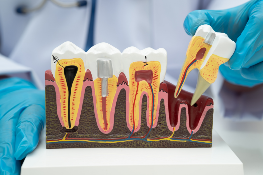 Root Canal Treatment in Ras Al Khaimah