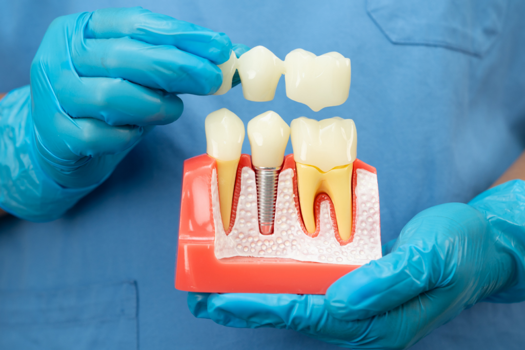 Root Canal Treatment in Ras Al Khaimah