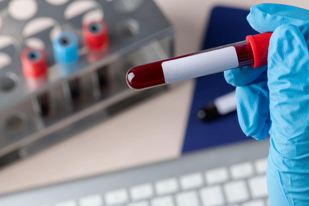 Blood Test in Ras Al Khaimah helping detect diabetes, cholesterol, anemia, and other health conditions early.